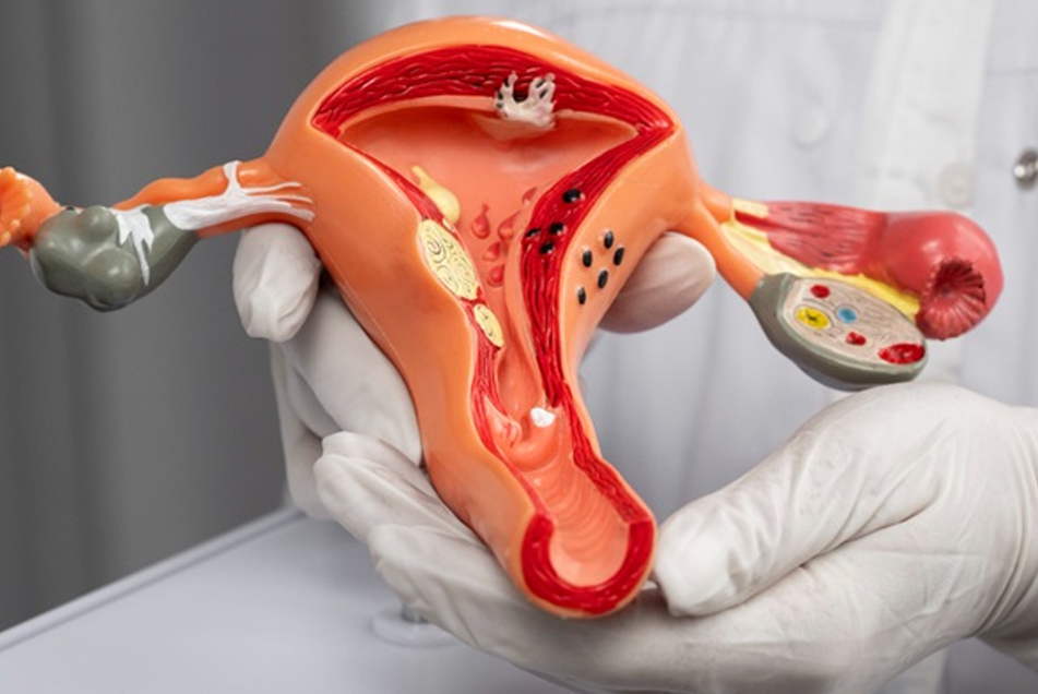 Fibroids Evaluation & Treatment Counseling
