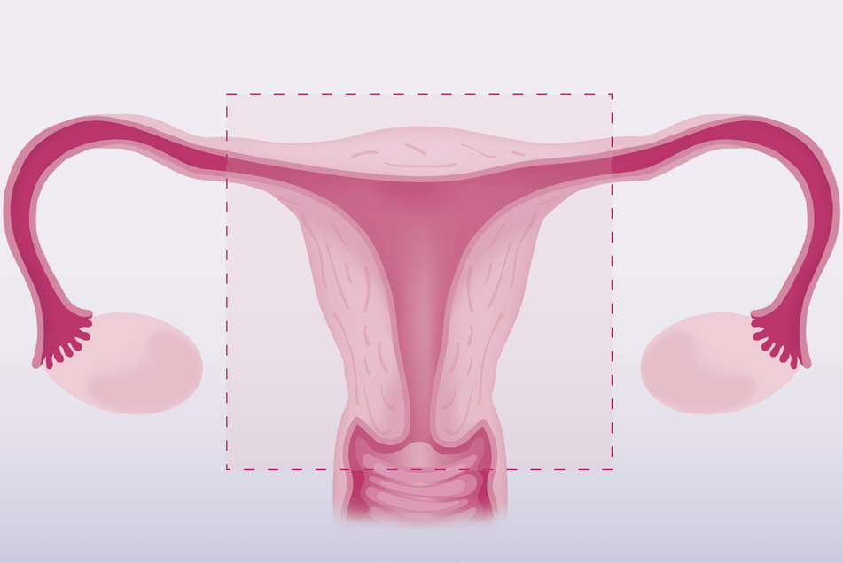 Hysterectomy – Counseling, Procedure & Recovery